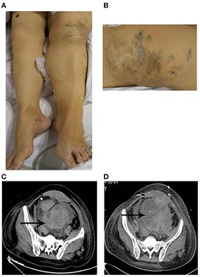 Case Report: Life-Threatening Post-operative Hemorrhage in Klippel–Trenaunay Syndrome Associated With <mark class="highlighted">Hypofibrinogenemia</mark>
